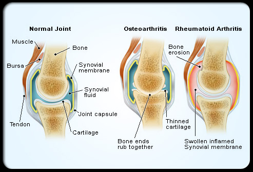 Rheumatoid Arthritis