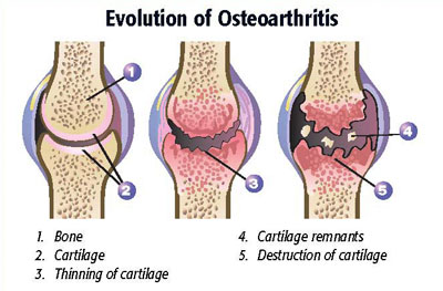 Progression of Osteoarthritis