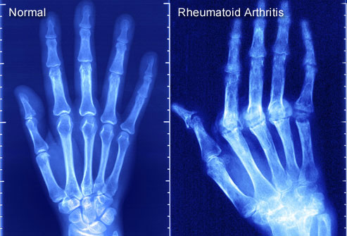 X-Ray of Rheumatoid Arthritis