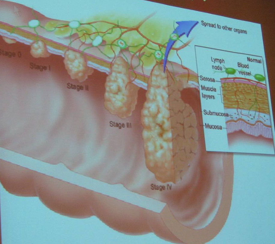 colon cancer symptoms stool color Clogged stools and colorectal cancer