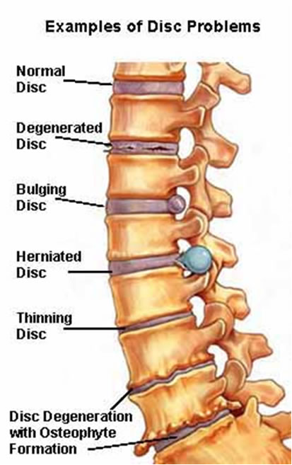 spinal-cure-without-surgery